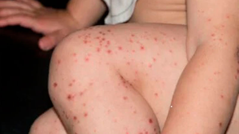 Alerta por contagios de virus Coxsackie, en kinder de Toluca