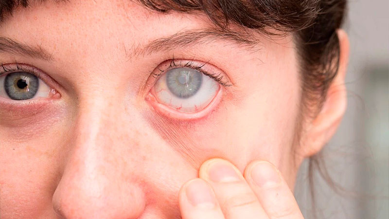 â€œVer por MÃ©xicoâ€, el programa de cirugÃ­as gratuitas de cataratas que ofrece Gobierno Federal