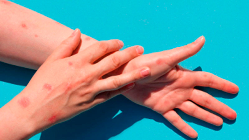 Mpox se dispara en México; se registran 174 casos en 2025