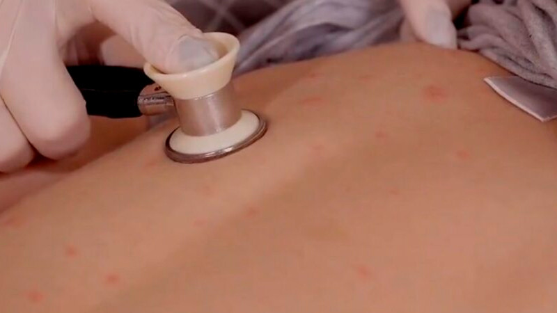 Salud confirma casi 2 mil casos de sarampión en México