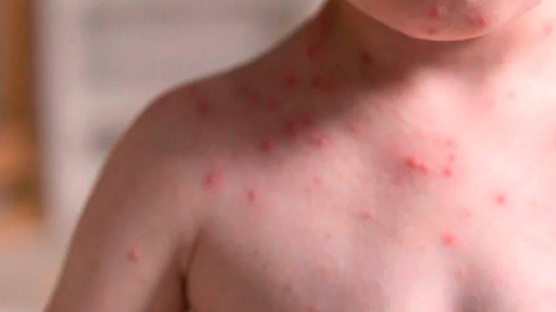 Casos de sarampión en México superan los 2 mil 400; el segundo país en América con más contagios 