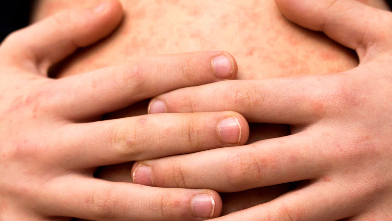 Van 1,288 casos de sarampión en EU; indican que es el peor brote en los últimos 33 años