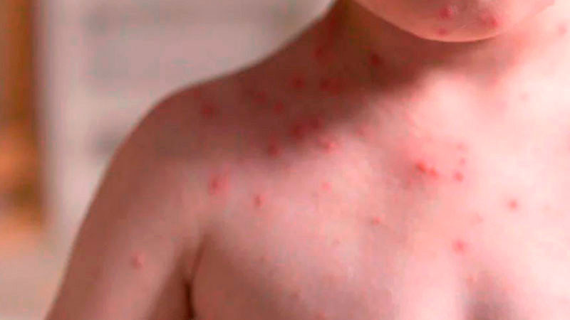 Suman 3 mil 129 casos de sarampión en Chihuahua; van 9 personas fallecidas 