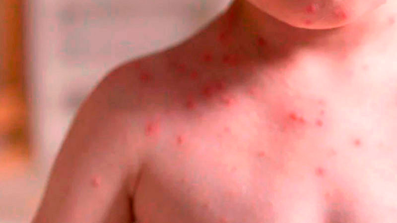 Brote de sarampión está contenido, asegura Salud; espera que ya no haya casos en noviembre